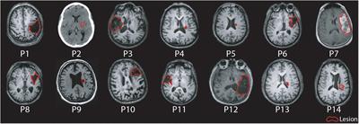 Paired Associative Stimulation as a Tool to Assess Plasticity Enhancers in Chronic Stroke